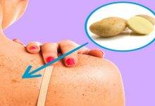 Natural Treatment for Age Dark Spots